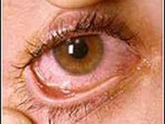   بیماری خشکی چشم چیست؟