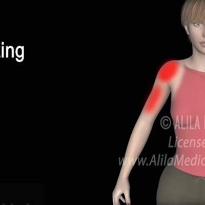 ویدئوی آموزشی درمان بیماری شانه منجمد یا کپسولیت چسبنده