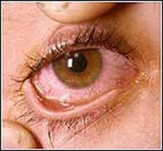   بیماری خشکی چشم چیست؟