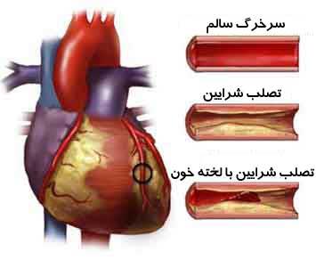 بیماریهای قلب و عروق 