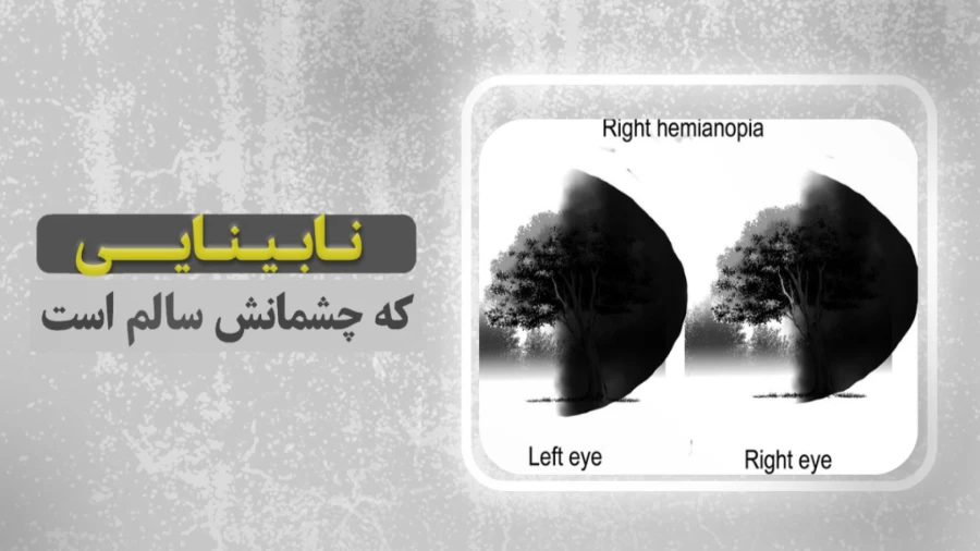 نابینایی که چشم هایش کاملا سالم است!!!