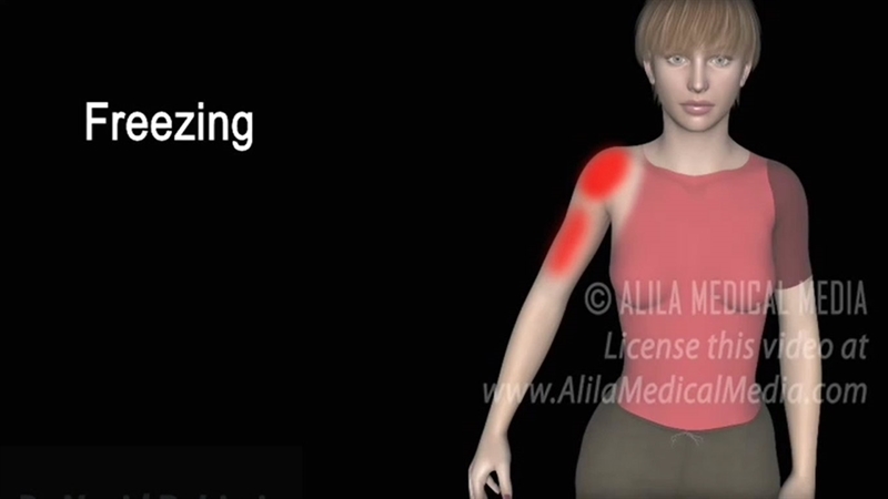 ویدئوی آموزشی درمان بیماری شانه منجمد یا کپسولیت چسبنده