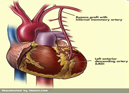 عوامل خطر ساز سکته های قلبی