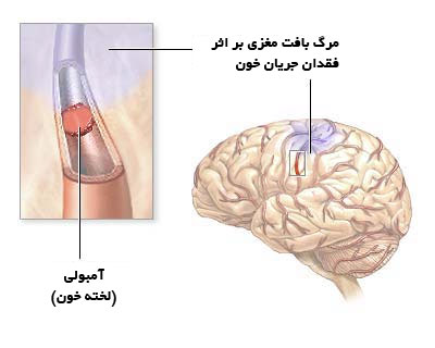 سکته مغزی (CVA یا Stroke)